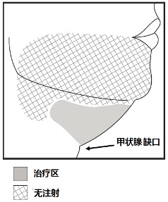 Kybella(去氧胆酸[deoxycholic <wbr>acid])注射液使用说明书2015年第一版