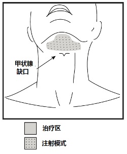 Kybella(去氧胆酸[deoxycholic <wbr>acid])注射液使用说明书2015年第一版